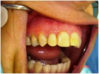 /album/galeria-de-fotos-carga-imediata-apos-exodontia-atraumatica-/carga-imediata-com-exodontia-atraumatica-jpg/